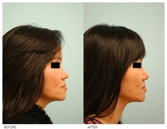 Asian Female Rhinoplasty before 136822