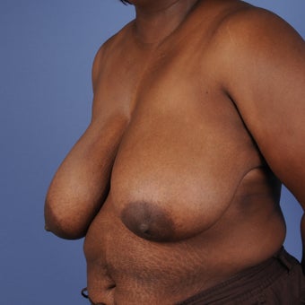 Breast Reduction 352964