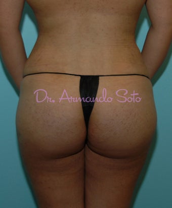 Brazilian Butt Lift after 207535
