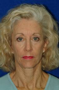 Facial Fat Grafting before 75980