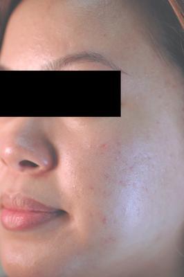 Laser Acne Treatment after 82975