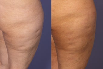 Cellulaze before 607925