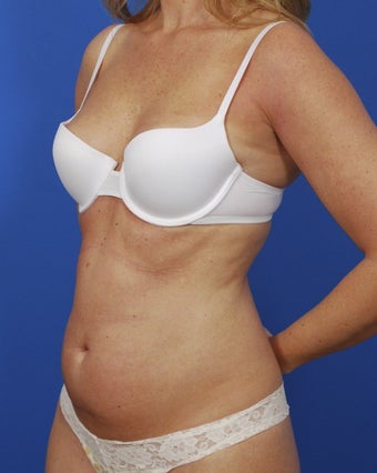 Laser Liposuction before 364486
