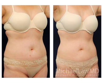Liposuction after 397198