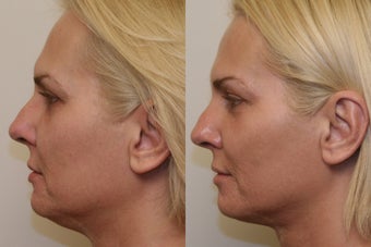 Ultherapy after 532607