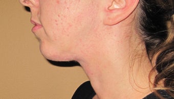 liposuction of double chin after 270057