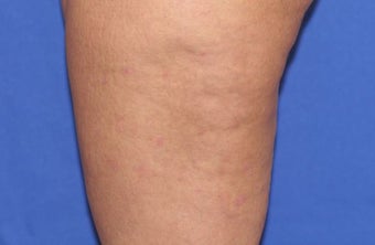 VASER Shape to Legs before 433064