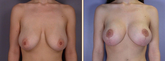 Mastopexy, Breast Lift before 270055