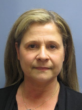 Neck Lift, Platysmaplasty before 634725