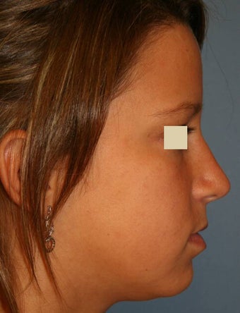 Rhinoplasty after 142567