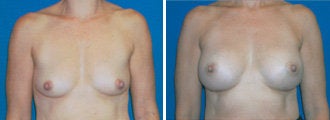 breast augmentation before 314009