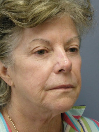 Obagi Blue Peel 635073