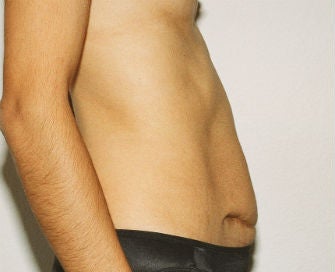 Abdominoplasty Revision before 493651