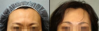 Endoscopic Brow Lift before 649389