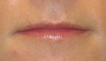 Juvederm before 53635