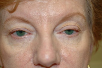 Cheek augmentation with cheek lift, ptosis repair, and elimination of festoons before 341472