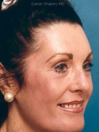 Full face laser resurfacing with endoscopic browlift and lower blepharoplasty after 250225