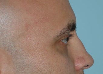 Non-Surgical Rhinoplasty before 118331