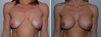 Breast implant revision before 332757