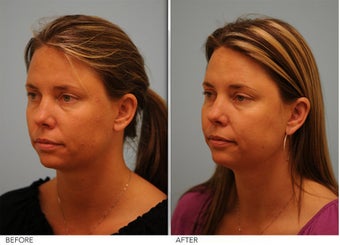 Otoplasty 306851