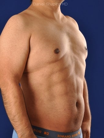 Vaser Hi-Def Liposuction of abdomen, chest, back and flanks 422693