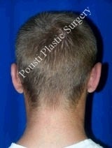 Ear Surgery (Otoplasty) after 616578