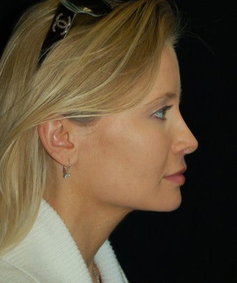 Revision Rhinoplasty after 392819