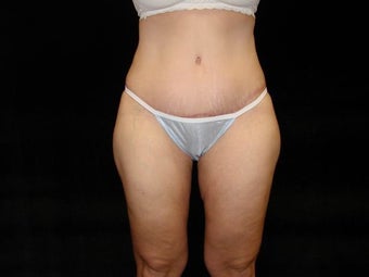 Extended Abdominoplasty after 203401