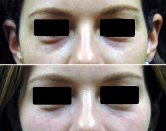 Filling of under-eye hollows / tear troughs with hyaluronic acid filler before 258109