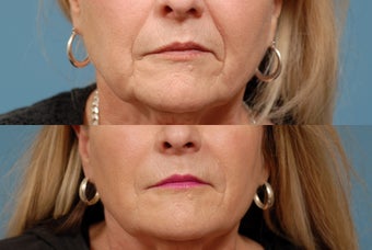 Sculptra before 409299