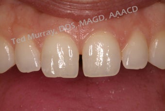 Cosmetic Bonding to close space 346955