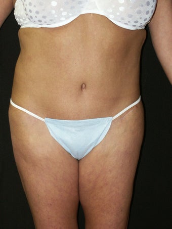 Body Lift after 379788