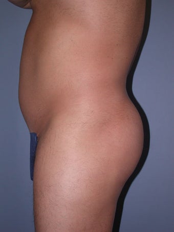 Liposuction 581412