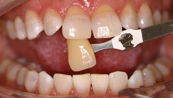 Teeth Whitening before 306937