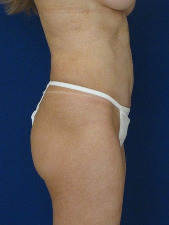 vaser Hi Def Liposuction of chest, abdomen, back and flanks 422723