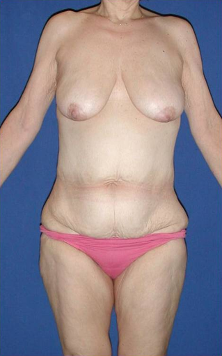 Complete Weight-Loss Makever (Body Lift, Breast Lift, Arm & Thigh Lift) before 533993
