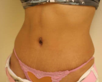 Abdominoplasty (Tummy Tuck) after 216676