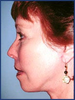 Mid facelift, lower facelift and upper blepharoplasty after 83177