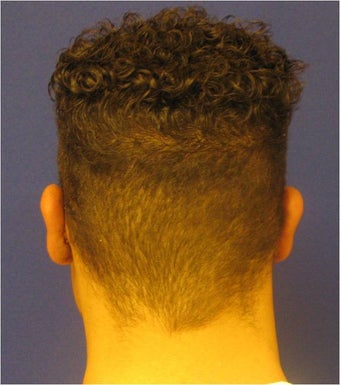 Otoplasty after 302918