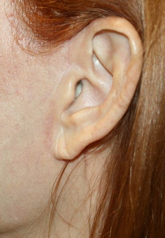 Earlobe filler before 393288