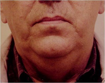 Lower face and necklift before 255548