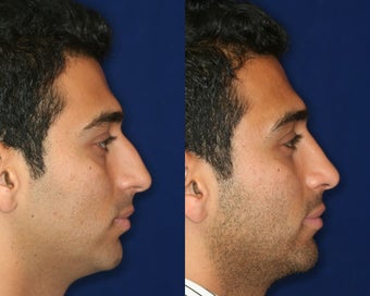 Rhinoplasty and Septoplasty before 223664