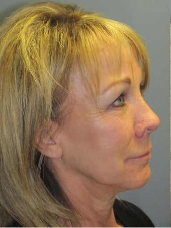 Obagi Blue Peel 635079