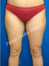 Liposuction before 632100
