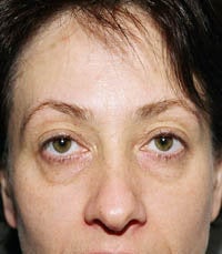 blepharoplasty (eyelids) before 219357