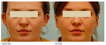Otoplasty (Cosmetic Ear Pinning) before 136390