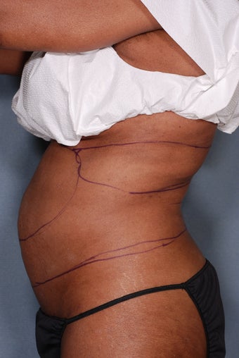 SmartLipo 356692