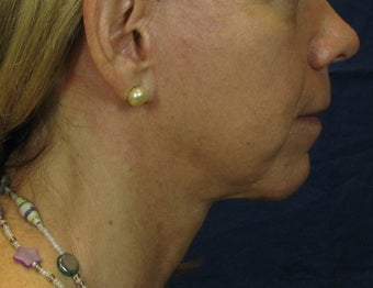 Laser Facelift after 249016