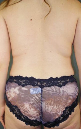 Pure Tumescent Liposuction after 552075