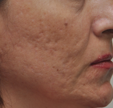 Acne Scarring 426030